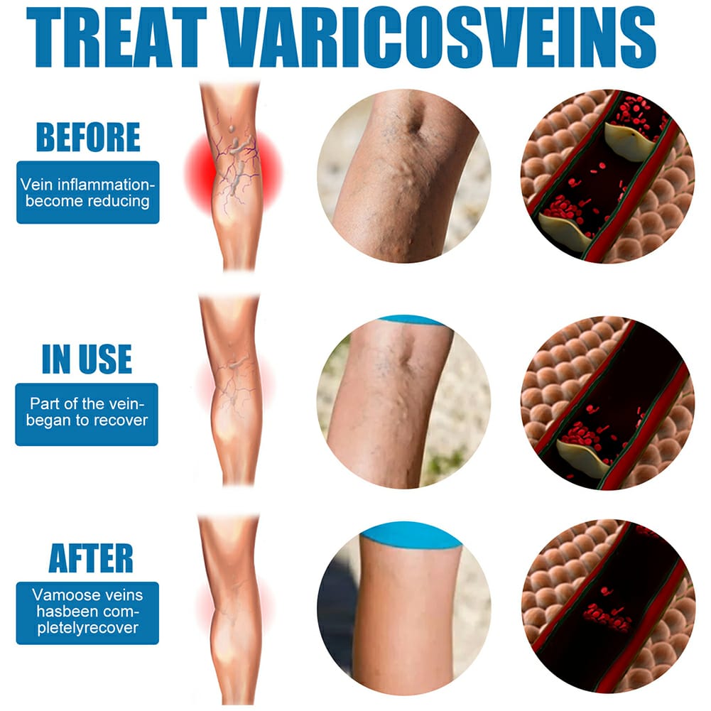 Varicose Veins Treatment Spray – Advanced Formula for Spider Veins, Leg Pain & Swelling Relief ~ 30ml