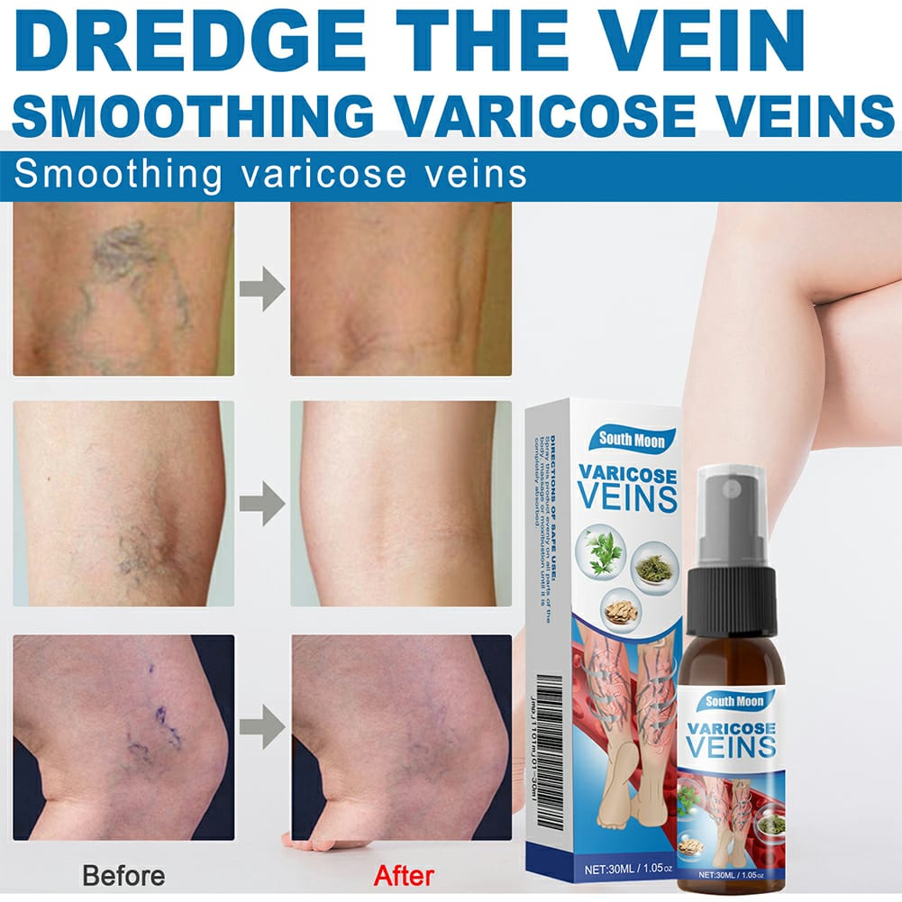 Varicose Veins Treatment Spray – Advanced Formula for Spider Veins, Leg Pain & Swelling Relief ~ 30ml